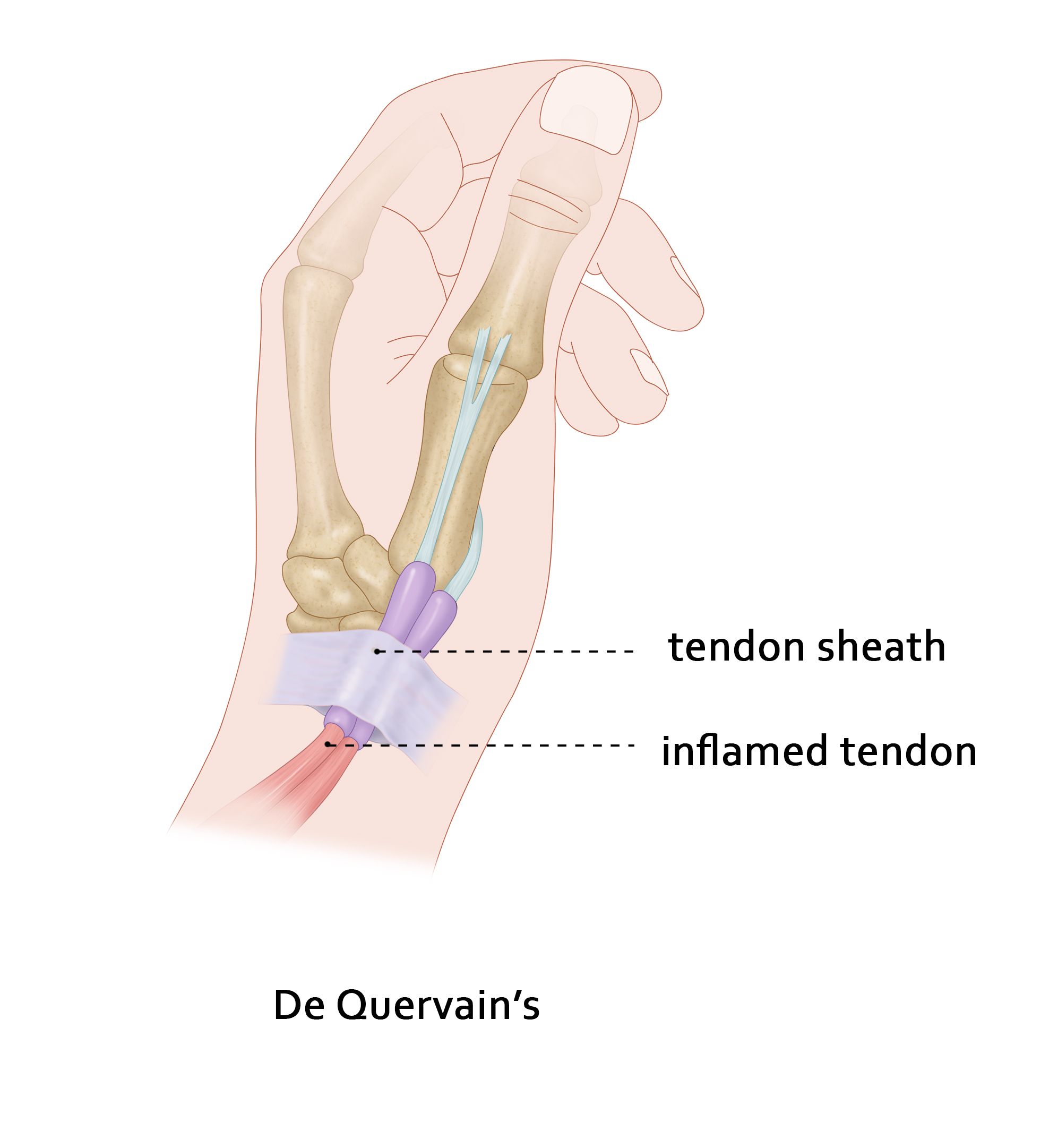 De Quervain's Tendonitis Sydney | Randwick Plastic Surgery